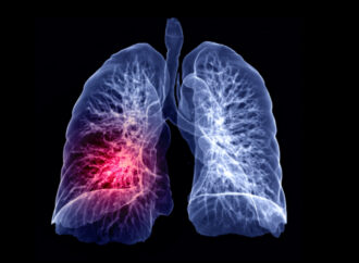 Protocolo de embolia pulmonar