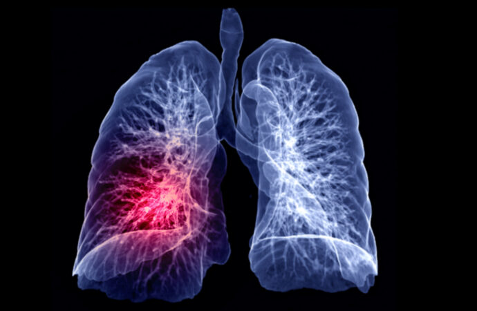 Protocolo de embolia pulmonar
